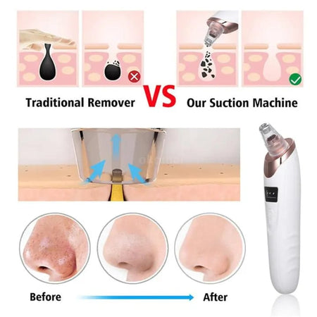 Face Vacuum Suction Blackhead Remover — Electric Deep Cleansing Tool